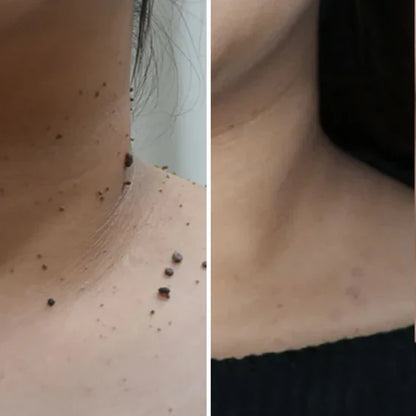 Velura™ | Mole & Skin Tag Removal Pen