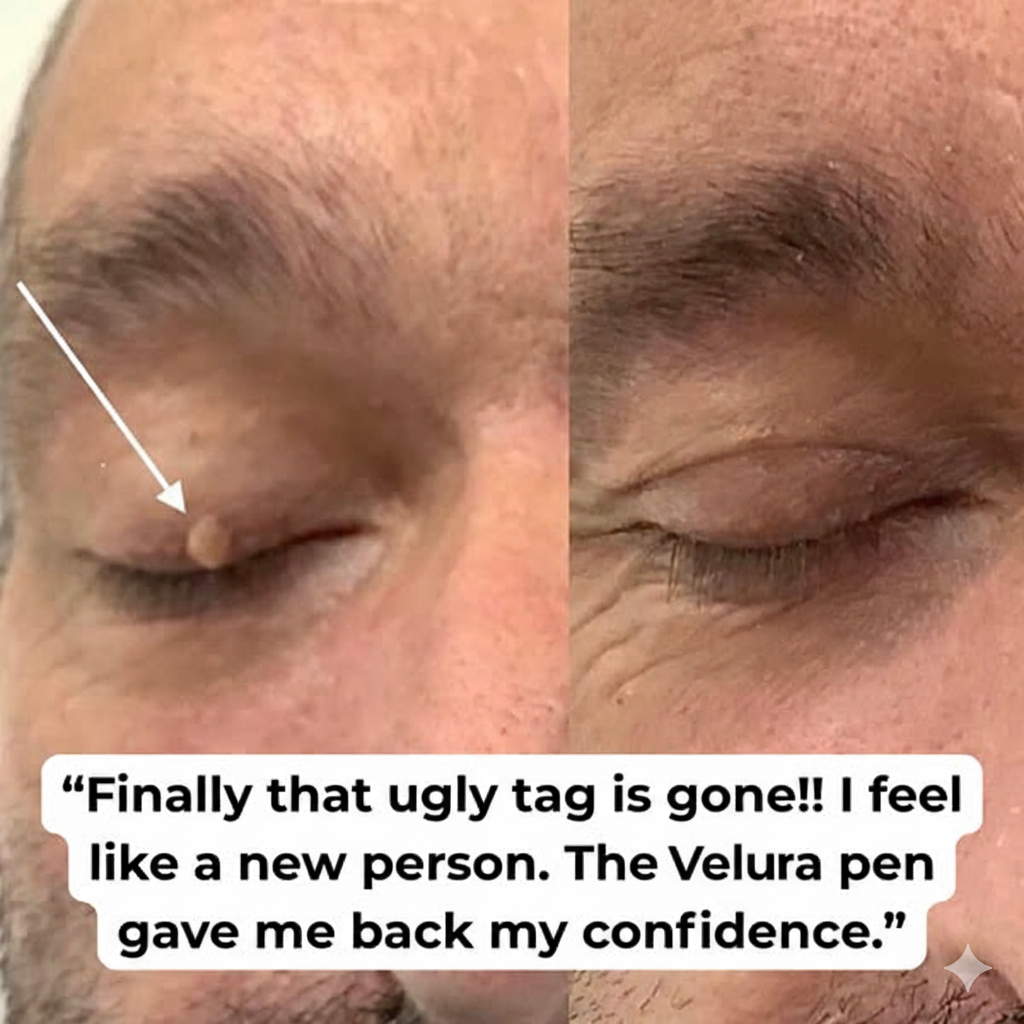 Velura™ | Mole & Skin Tag Removal Pen